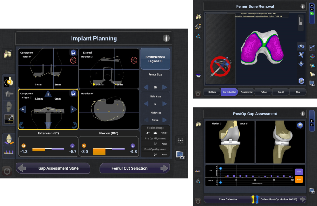 Robotic Knee Replacement Surgery Guide Dr Shiva Reddy