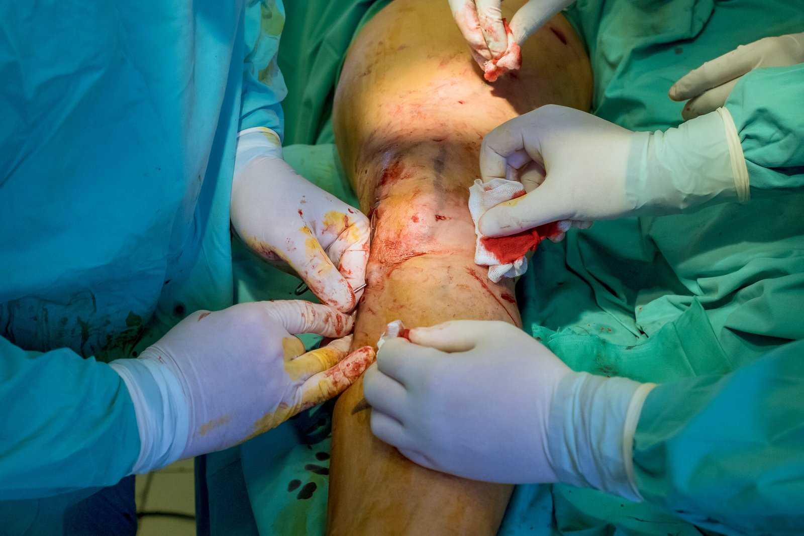 ACL Reconstruction Surgery in Bangalore