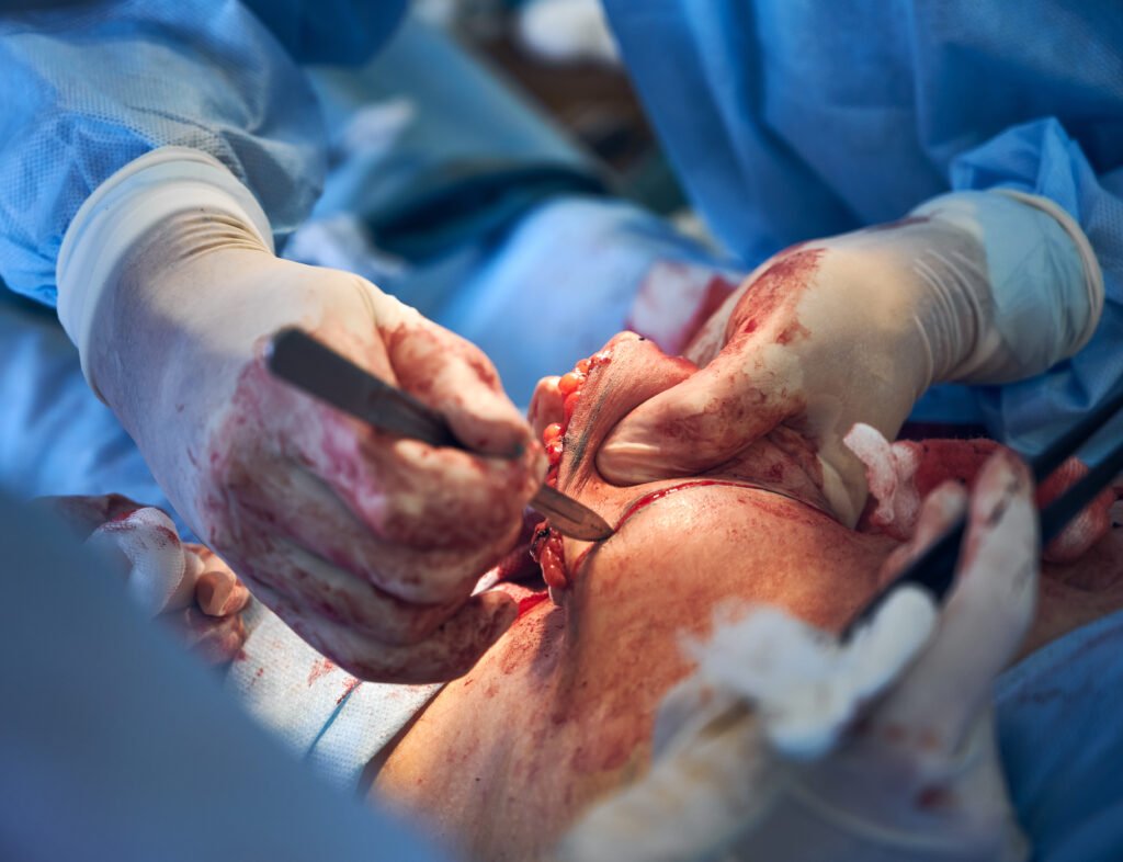 ACL Reconstruction Surgery in KR Puram